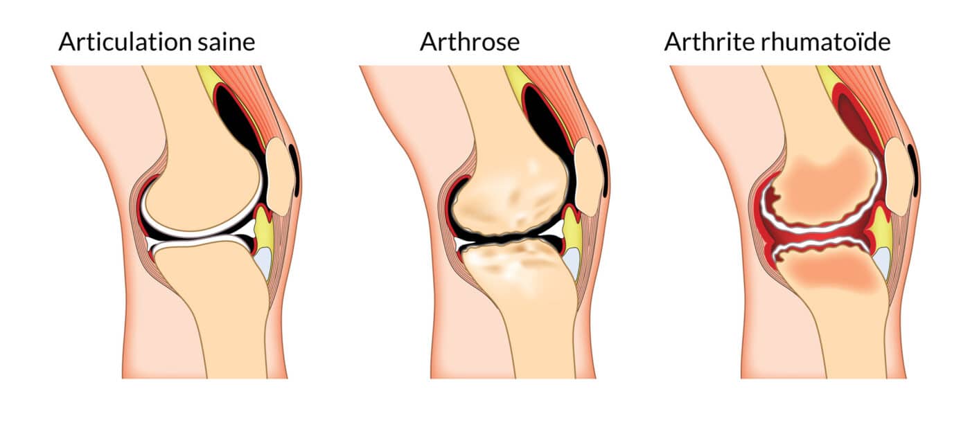 arthrose-vs-arthrite