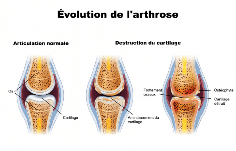 evolution-de-larthrose